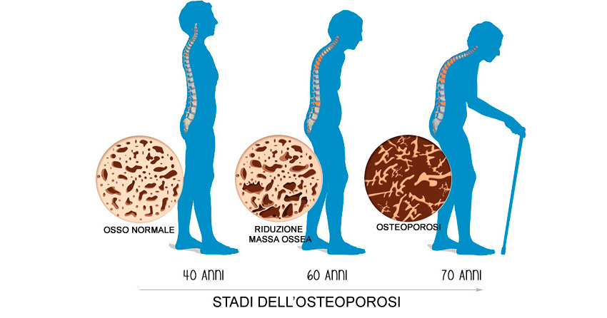 osteoporosi11 - Iniziative per l'Ottobre Rosa